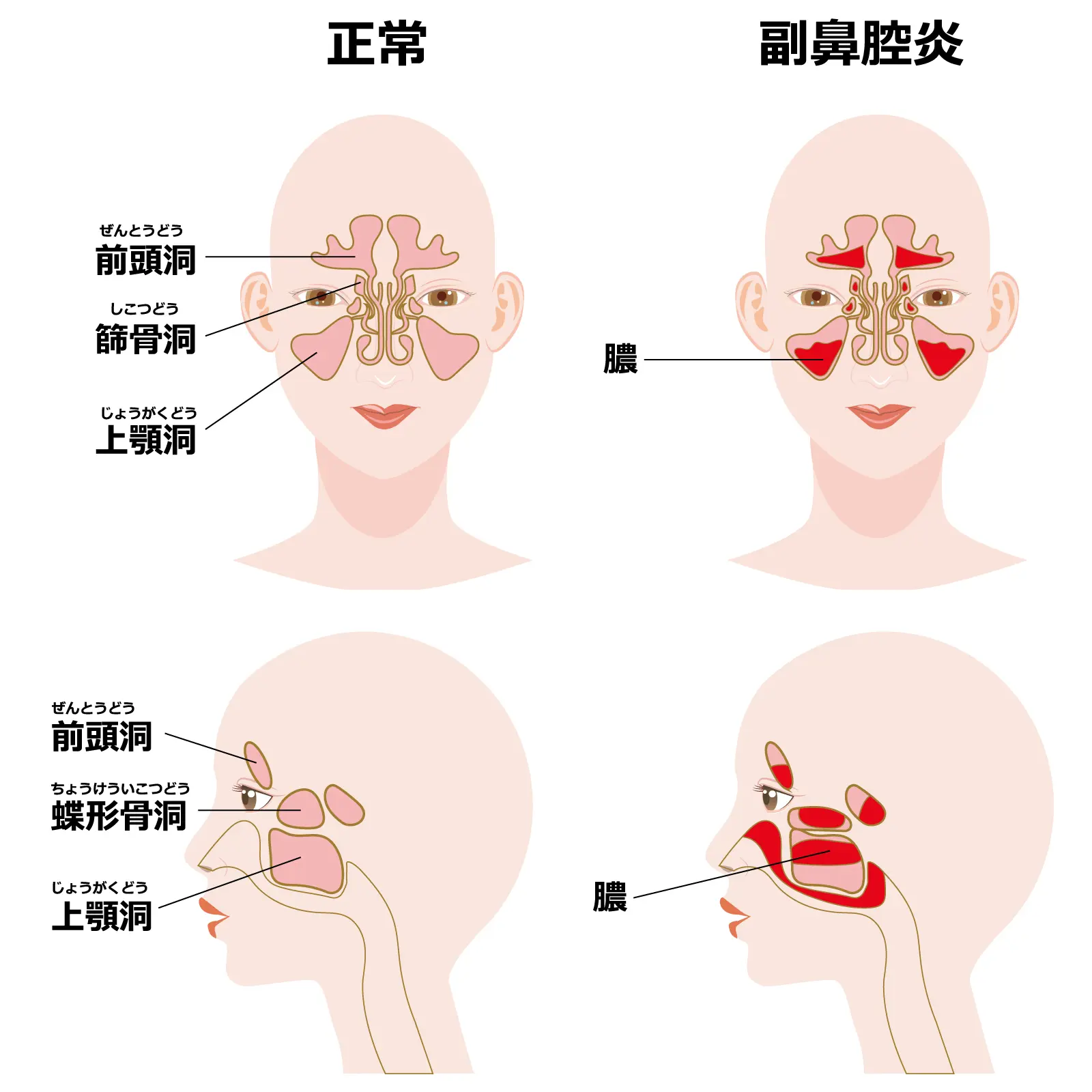 副鼻腔炎