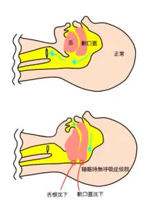 睡眠時無呼吸症候群（SAS）の原因