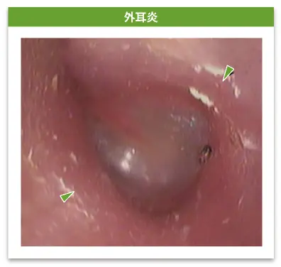 外耳炎
